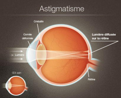 Astigmate1